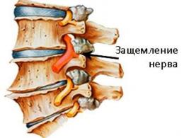 Защемление сердечной мышцы симптомы