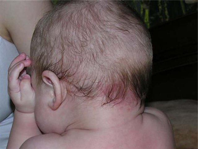Как проявляется корь у детей фото начальная стадия Как проявляется корь у детей фото начальная стадия